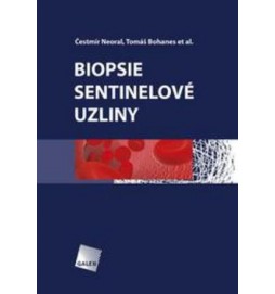 Biopsie sentinelové uzliny